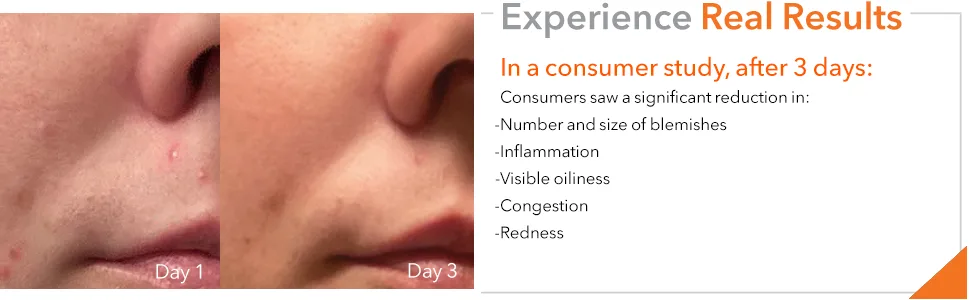 Dr Dennis Gross DRx Blemish Solutions Acne Eliminating Gel: for Frequent Breakouts  Congestion  Bumpy Texture & Oily Skin  1.0 fl oz - DRx Blemish Solutions Acne Eliminating Gel
