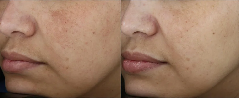 Colorescience Even Up Multi-Correction Serum  1 fl. oz. - Customer before and after 12 weeks