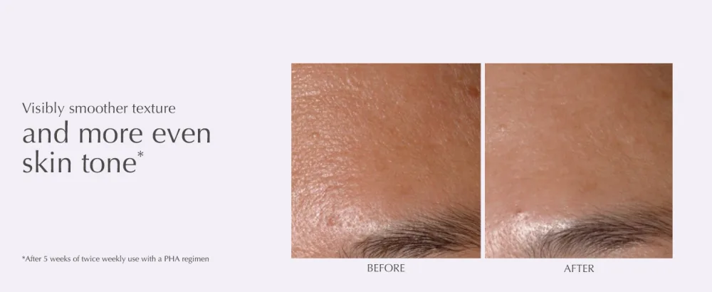 EXUVIANCE Performance Peel AP25 At-Home Chemical Peel with Glycolic  Mandelic and Polyhydroxy Acids  13 ct. - Before & After