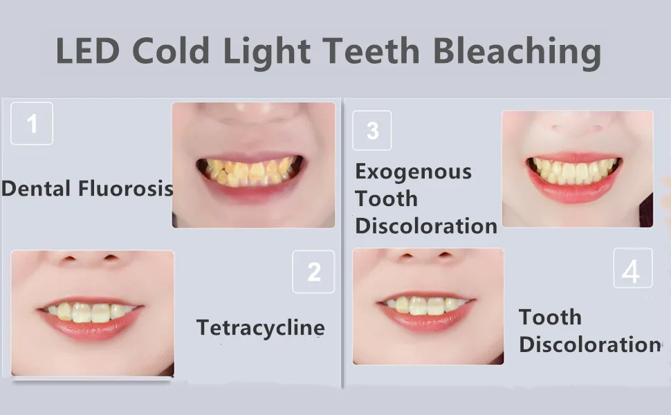 Dental Teeth Whitening Lamp Teeth Bleaching Light Lamp Blue Red Light Lamp Floor Standing - Teeth Whitening Bleaching Accelerator