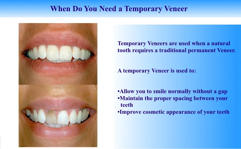 Impressive Smile Ultra Thin Tooth WHITENING VENEERS | COSMETICALY Realistic Looking Solution for Missing OR Broken Teeth | Choose Shade A-1  A-2 or A-3 (A-2) - Temporary veneer improves cosmetic appearance of your teeth