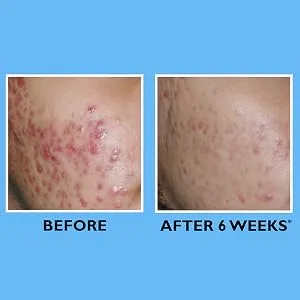 Peter Thomas Roth | Goodbye Acne Complete Acne Treatment | Gel to Clear  Prevent  Treat and Calm Acne  Post Acne Mark Treatment - Peter Thomas Roth, Goodbye Acne Complete Acne Treatment Gel, before and after, b&a, results