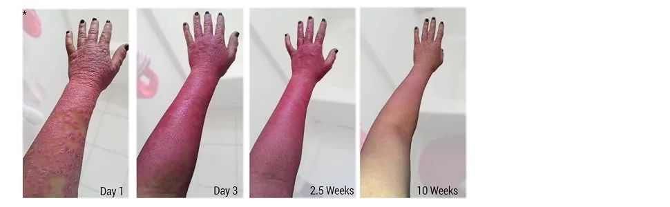 TriDerma Psoriasis Control Moisturizing Cream for Psoriasis Treatment with Salicylic Acid (6 Ounce) - Before and After