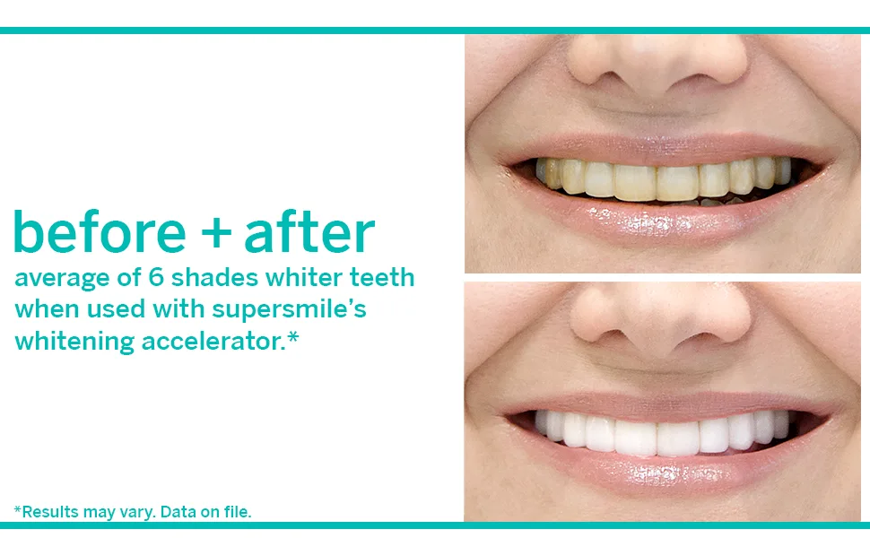 Supersmile Professional 4-Piece Flavor Sampler Kit w/ Whitening Toothpaste  Accelerator & Toothbrush - before + after supersmile toothpaste
