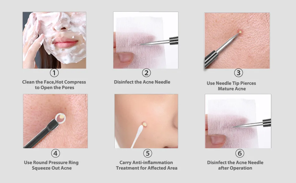 Glamne Blackhead Remover Pimple Popper Kit Acne Comedone Extractor Blemish Extraction Popping Tools (Black) - blackhead remover tool