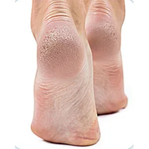 DEFUTAY Foot File Callus Remove Metal Tool Heel Foot Scraper for Dead Skin Callus Hard Skin Remover  Cracked Heelr (Black) - Callus Remover