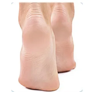 DEFUTAY Foot File Callus Remove Metal Tool Heel Foot Scraper for Dead Skin Callus Hard Skin Remover  Cracked Heelr (Black) - Callus Remover