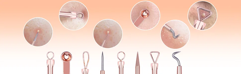 DUcare Blackhead Remover Comedone Extractor Acne Removal Kit for Blemish  4Pcs Professional Pimple Popper Tool Kit  Stainless Steel (Gold) - Blackhead Remover