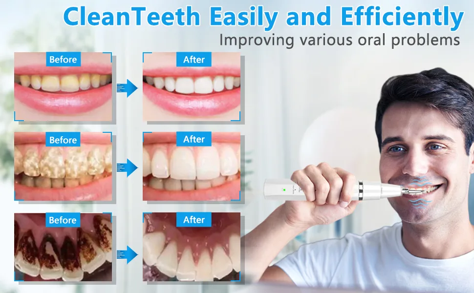 Plaque Remover for Teeth- LYMI Remove Teeth Stain tarter Plaque Calculus-with Led 5 Adjustable Modes 3 Replaceable Clean Heads -Safe(White) - product information 4