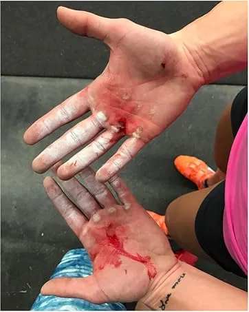 Prevent Hand rips and Improve Workouts with The Callus Performance Bundle. Includes 2 Smoothing caps and a Callus Shaver  Smoother  and Remover. Perfect for Crossfit and The Gym - ripped callus