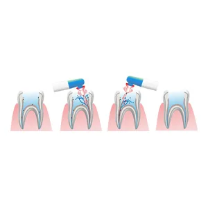 Easyinsmile Dental Endodontic Activator Tips Soft Bendable Polymer Material Never Breaking File (Tips) - Easy Activator
