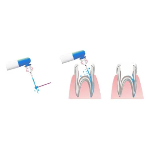 Easyinsmile Dental Endodontic Activator Tips Soft Bendable Polymer Material Never Breaking File (Tips) - Easy Activator