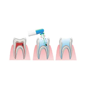 Easyinsmile Dental Endodontic Activator Tips Soft Bendable Polymer Material Never Breaking File (Tips) - EASYDO ACTIVATOR