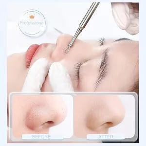 Professional Blackhead Remover Titanium Lancet Needle Acne Blackhead Remover Pointed Pimple Extractor Blackhead Removal Tool(Sliver) Silver-1pc - 2-in-1 popper tool