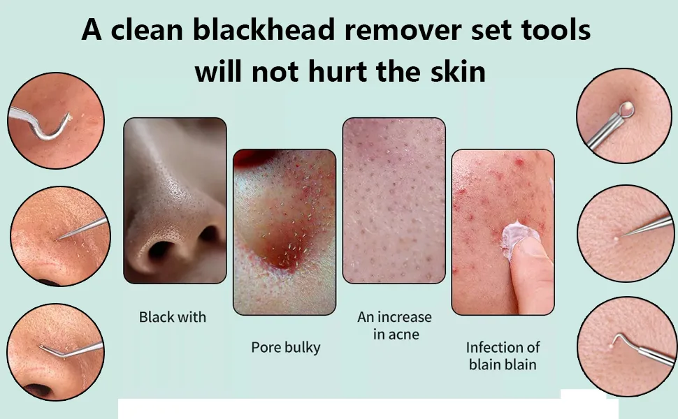 Blackhead Remover 16pcs Kit with Portable Box - Blackhead Remover