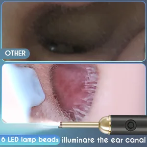 Upmore Ear Wax Removal Tool  Ear Cleaner with Camera 500W Pixel HD  Ear Camera Otoscope with 6 LED Light  Ear Wax Removal kit for iOS Android. White - ear wax removal tool