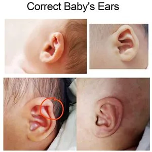 Auricle Correction Patch  Baby Ear Aesthetic Corrector Infant Silicone Baby Auricle Valgus Correction Patch  Baby Ear Corrector for Babies with A Pair Ear Supports  Children Ear Correction - product information 18