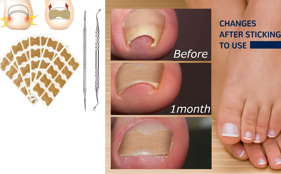 100PCS Toenail Corrector Patch Ingrown Toe Nail Correction Sticker  Health Toenail Corrector Patch  Ingrown Toenail Tool - product information 32