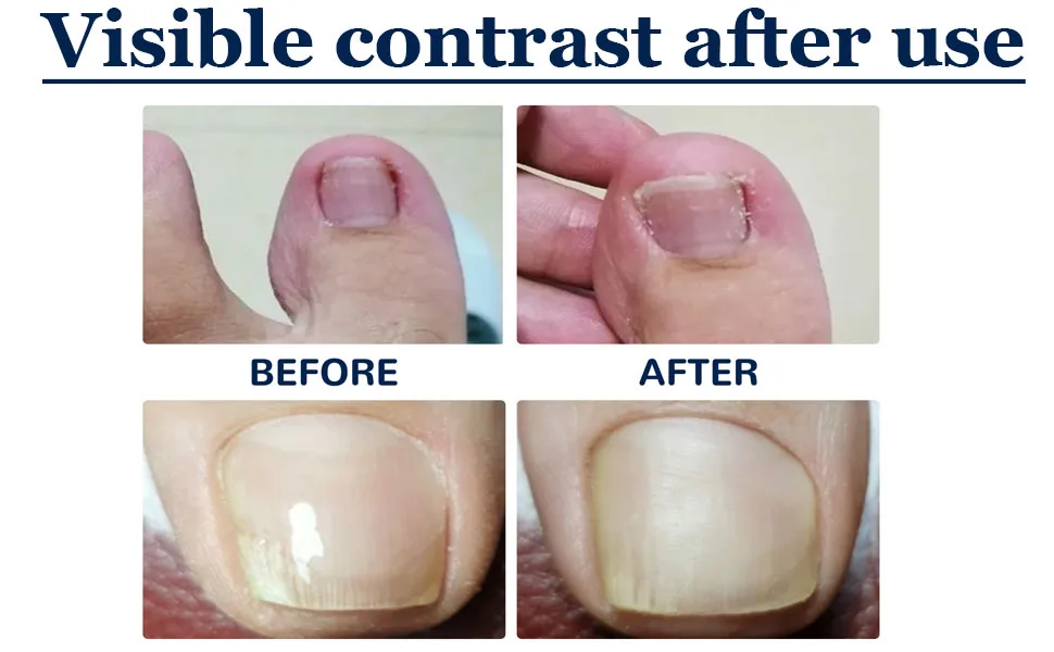 100PCS Toenail Corrector Patch Ingrown Toe Nail Correction Sticker  Health Toenail Corrector Patch  Ingrown Toenail Tool - product information 33