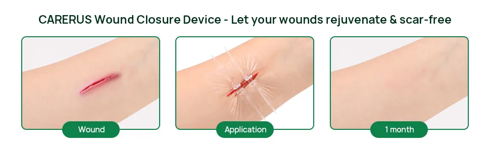 5pcs Suture Free Wound Closure Strips  Zip Stitch Sutures  Butterfly Bandaids  Emergency Wound Closure Device  Laceration Repair Without Stitches  Wound Care for First Aid Kits - steri strips wound closure