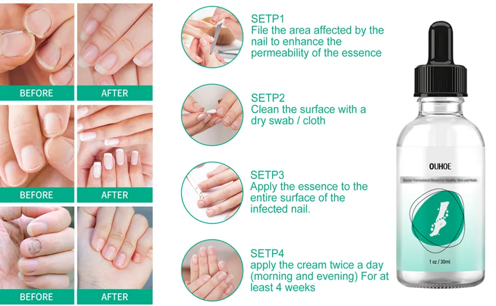 Kerassentials Toenail Treatment Oil Kerasentials for Toenail Kerasentials Nail Treatment May Support Strong Healthy Natural Nails 3PCS - oil 3