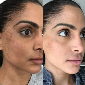 Dark Spot Fast + Natural Serum - Treatment for Melasma  Hyperpigmentation  and Discoloration Correction - Cleanser