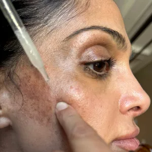 Dark Spot Fast + Natural Serum - Treatment for Melasma  Hyperpigmentation  and Discoloration Correction - dark spot serum