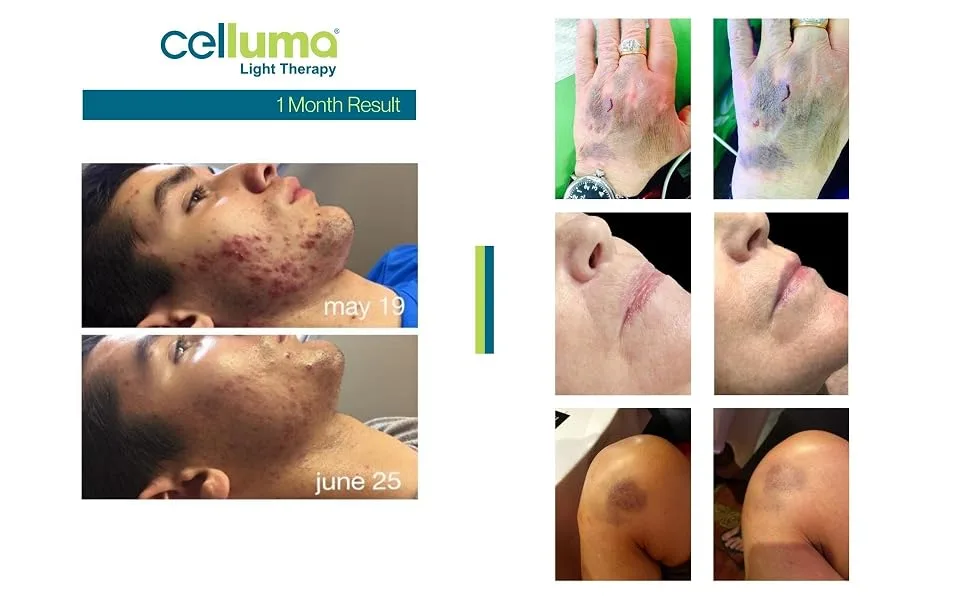 Celluma CLEAR | LED Light Therapy For Acne On The Face  Chest  Shoulders and Back - Transformation