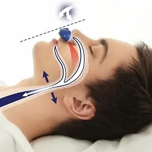 ROOHO Anti Snoring Device  Adjustable Wind Speed Snoring Solution  Stop Snoring Suitable for Men and Women  Electric Anti Snoring Devices Nasal Dilator Nose Vents Plugs Blue - anti snoring device