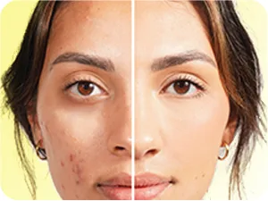 HIDE PREMIUM Liquid Multi-Use Concealer  SEE SHADE FINDER Below For Perfect Match  Large Bottle 0.5 fl. oz. - Full Coverage Concealer Makeup for Acne Dark Spots Dark Circles Hyperpigmentation and Blemishes Oil Free Conce... - before and after