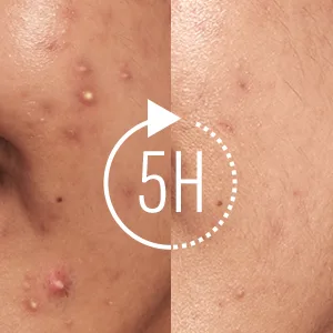 LitBear Acne Patch Pimple Patch  2 Sizes 138 Patches Professional Acne Absorbing Cover Patch for Men  Hydrocolloid Invisible Acne Patches For Face Zit Patch Acne Dots Tea Tree  Calendula Oil - acne patches