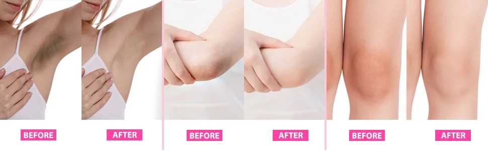 2Pcs Dark Spot Corrector Cream  Dark Spot Remover for Body  Underarm Cream  Armpit  Neck  Back  Knees  Elbows  Private Areas  Intimate Areas  2PCS x 60ML - Dark Spot Corrector Cream