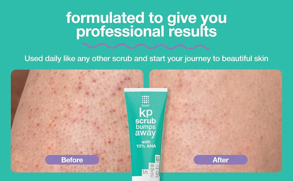 Touch KP Scrub Bumps Away Exfoliating Rough & Bumpy Skin Body Scrub for Keratosis Pilaris with 10% AHA - 8 oz - KP Scrub - Before and After
