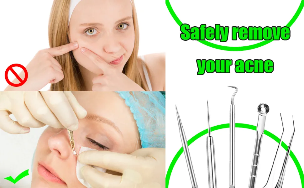 Blackhead Remover Tool  Stainless Steel Pimple Popper Tool Kit  Blackhead Extractor Tool for Face  5-in-1 Blackhead Remover Tool *4 Tweezers *1-0414042 - product information 1