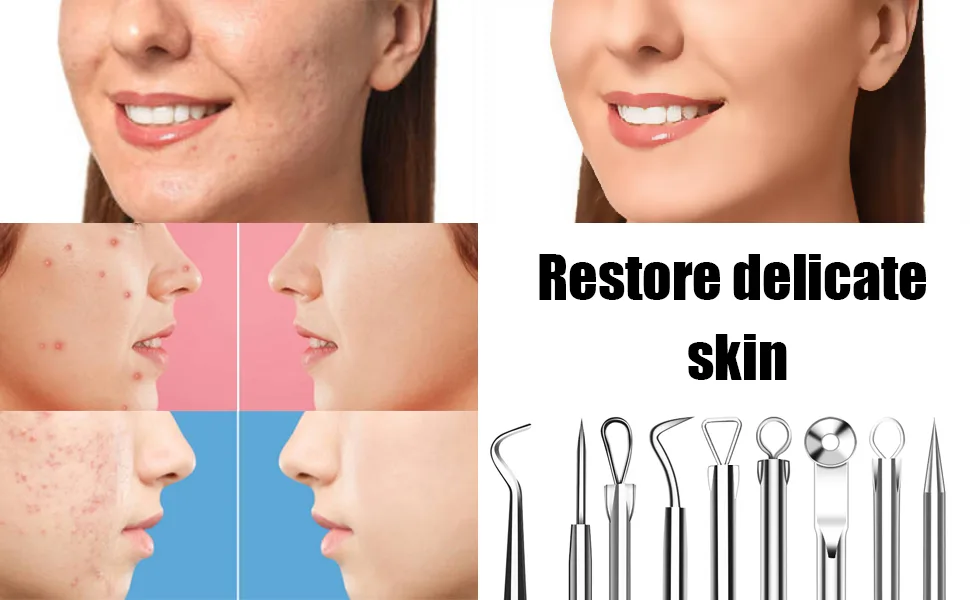 Blackhead Remover Tool  Stainless Steel Pimple Popper Tool Kit  Blackhead Extractor Tool for Face  5-in-1 Blackhead Remover Tool *4 Tweezers *1-0414042 - product information 5