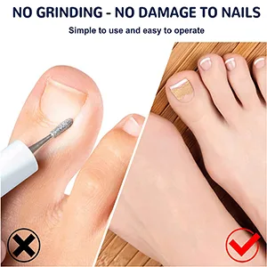 100 PCS Toenail Correction Patch  Breathable Self-Adhesive Elastic Toenail Correction Patch  Health Toenail Corrector Patch  Ingrown Toenail Correction Stickers Blue - product information 3