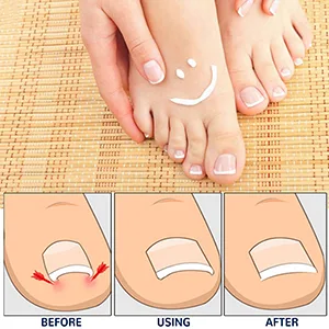 100 PCS Toenail Correction Patch  Breathable Self-Adhesive Elastic Toenail Correction Patch  Health Toenail Corrector Patch  Ingrown Toenail Correction Stickers Blue - product information 5
