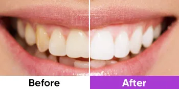 Purple Toothpaste for Teeth Whitening - Tooth Stain Removal Purple Toothpaste Teeth Colour Correcting Teeth Whitener - remove teeth stains