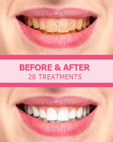 Hot Pepper Professional Teeth Whitening Strip Kit with 8% Pap  56 Pouches 112 Strips Total (Coconut) - teeth whitening strip
