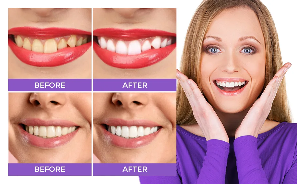Purple Teeth Whitening: Advanced Teeth Whitening  Stain Removal  and Boosting Power with Purple Whitening Tooth Foam (50ml) - teeth whitening 5