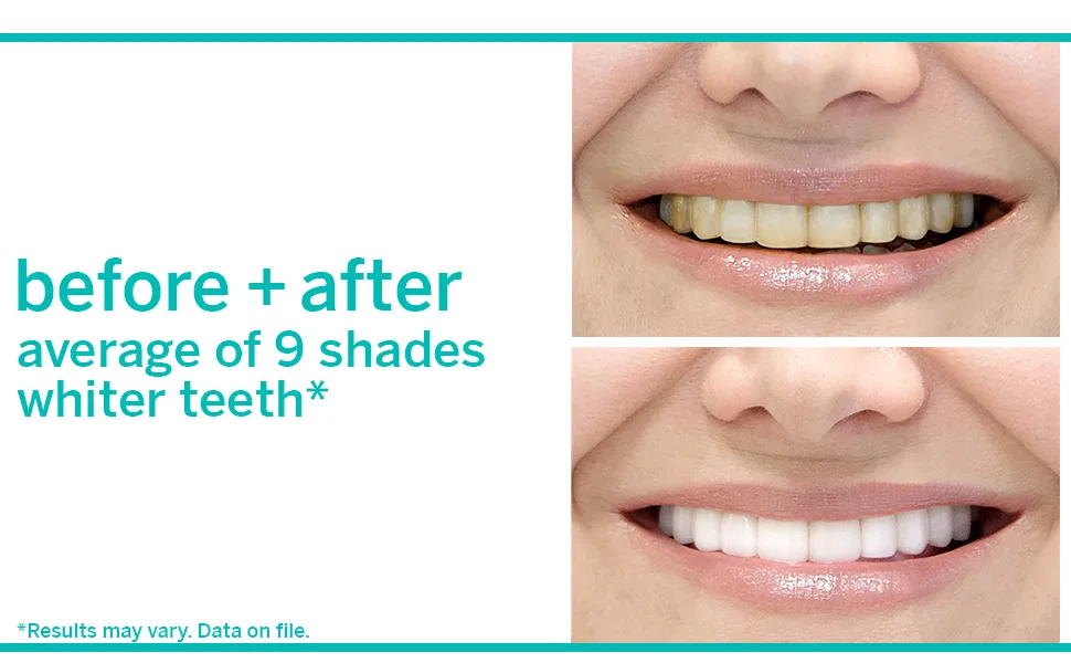 Supersmile Extra White Teeth Whitening System   2 Count (Pack of 1) - before + after