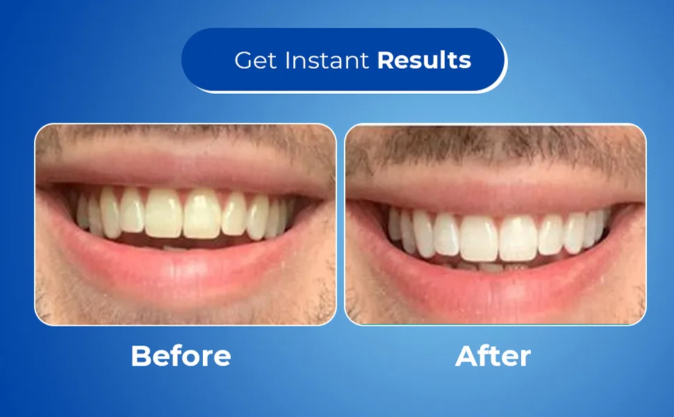 CustMbite Premium Teeth Whitening Gel Applicator  44% Carbamide Peroxide  (3) 3ml Applicators 1 Fl Oz (Pack of 1) - Get Instant Results