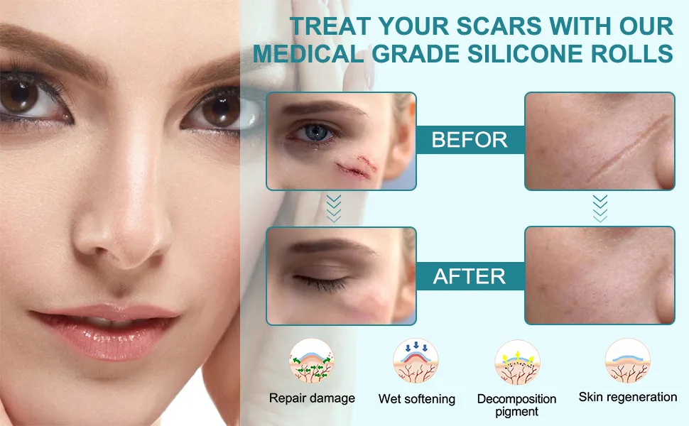 Silicone Scar Tape Roll(1.5M) Medical-Grade Silicone Scar sheets Professional Scar Strips Scar Sheets For Surgical Scars C-Section Surgery Scar - Silicone Scar Sheets