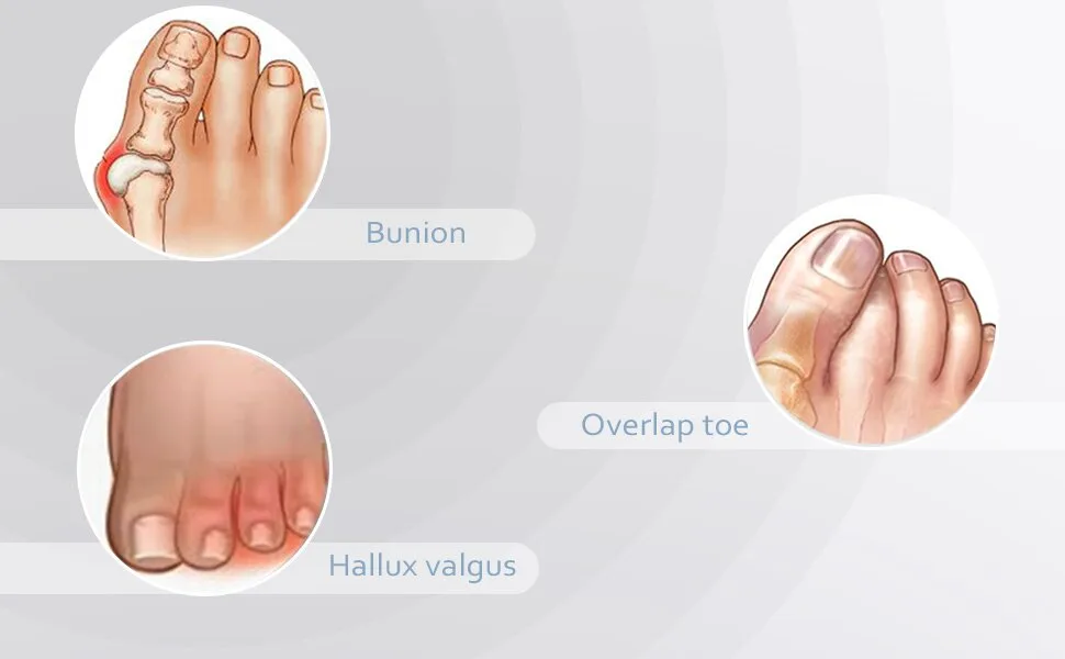 MHSY Toe Separators for Overlapping Toes 4PCS Gel Bunion Correctors Toes Spacers for Hallux Valgus and Hammer Toe Relieve Pain Blue - Toe Separators for Overlapping Toes