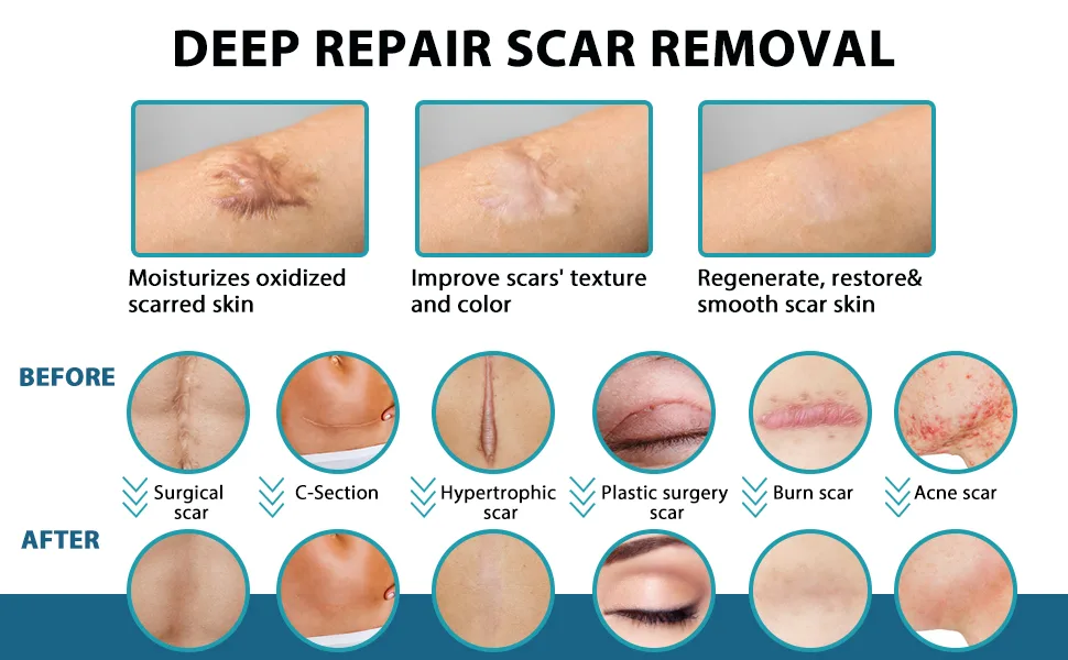 Medical Grade Silicone Scar Sheets (1.6 x60 ) Professional Scar Removal Sheets for C-Section Surgery Burn Keloid Acne et - scar