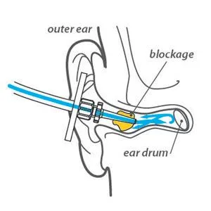 HEAR Ear Wax Removal Kit Includes: Wash Basin 3 Soft Disposable Tips Irrigation System to Clean Outer Ear - HEAR softtouch ear drops earwax ear wax ear clean wash irrigation swabs blockage kit removal remover