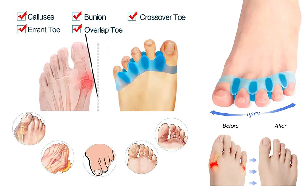 1 Pair Toe Separators Silicone Toe Spacers for Bunions Overlapping Hammer Toe(Blue) - product information 3