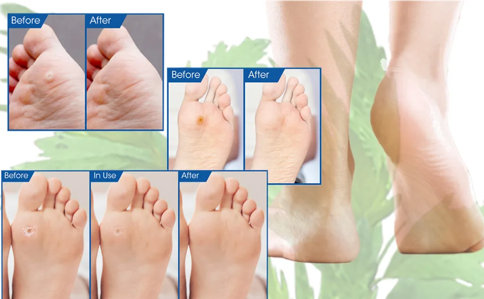 Gelanori Corn Removers for Feet and Toe Foot Care corn pads (20pcs) - corn pads