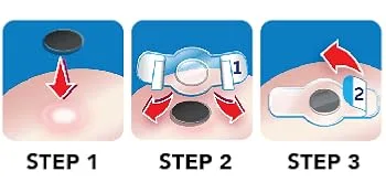 Dr Scholl's Duragel Corn Remover 0.1 Pound Old - How To Use