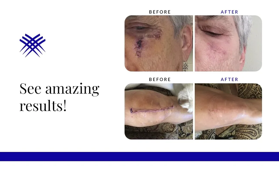 Rejuvaskin Scar Heal Kit - 1 x 22 - product information 4